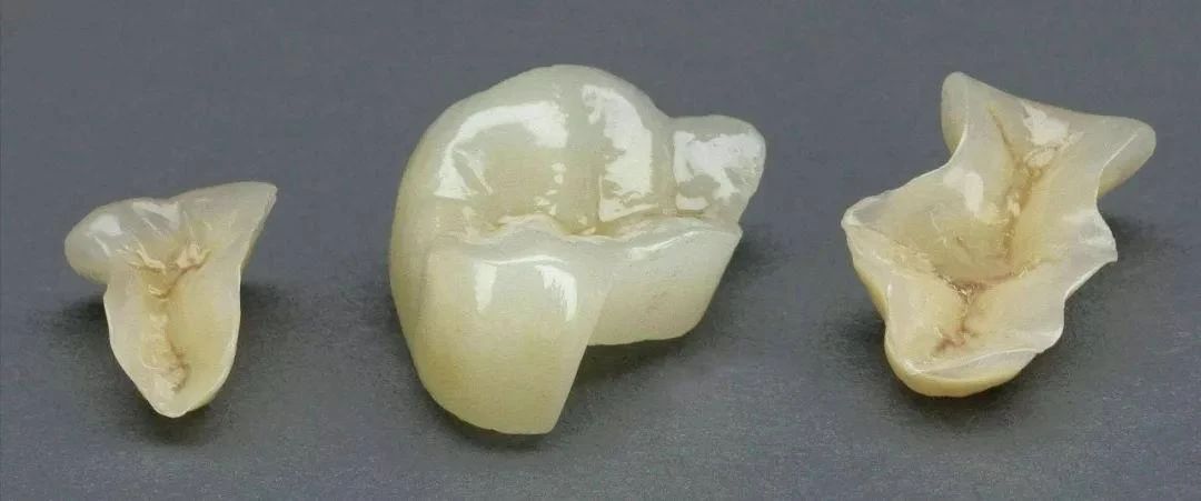 嵌体补牙好不好？
