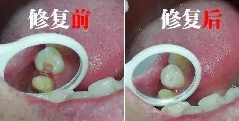 嵌体补牙多少钱一颗