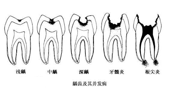 牙齿龋坏的危害？
