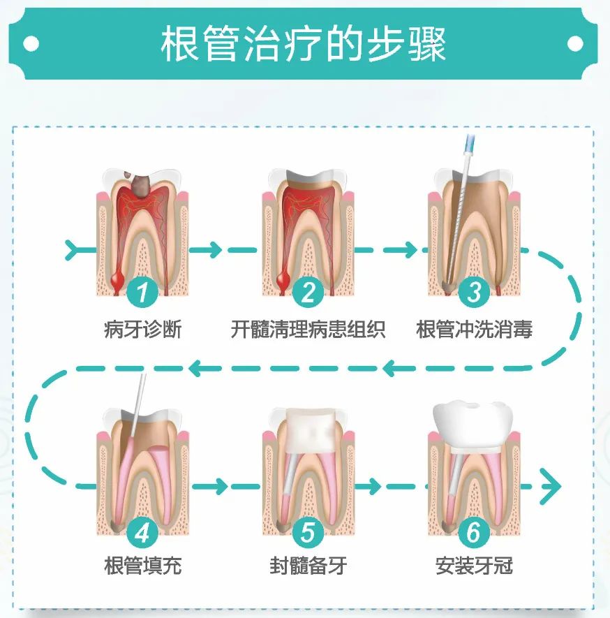 根管治疗不做冠,牙齿必留下后患