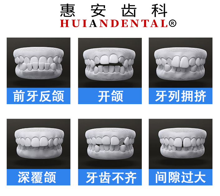 哪些人需要做牙齿矫正？